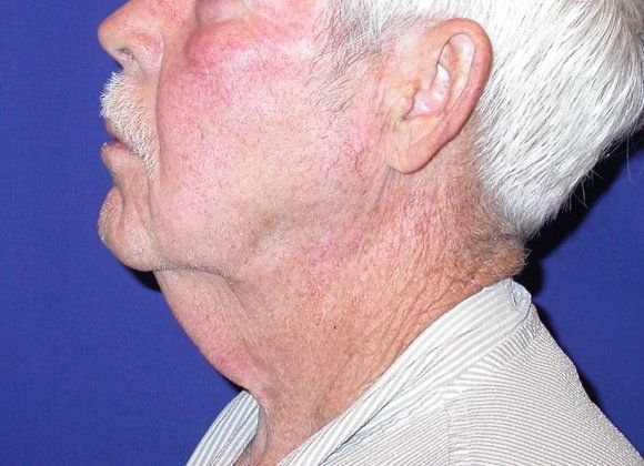 Before Image: Case #371 – Neck Lift – Direct (For Men) - left-side