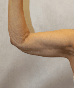 Case #3725 – Brachioplasty