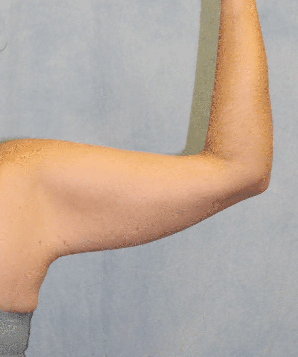 After Image: Case #3736 – Brachioplasty - back