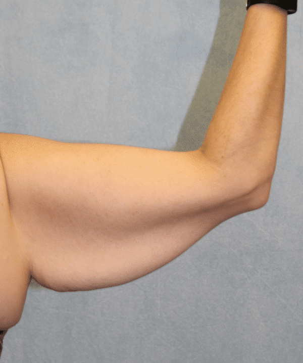 Before Image: Case #3736 – Brachioplasty - back