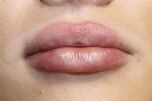 Case #3741 – Lip Filler