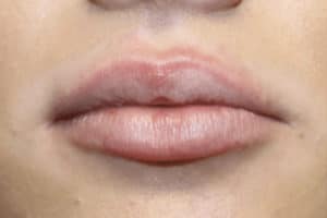 Case #3741 – Lip Filler