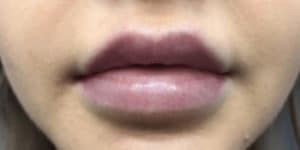 Case #3749 – Lip Filler
