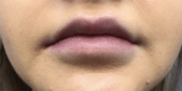 Case #3749 – Lip Filler