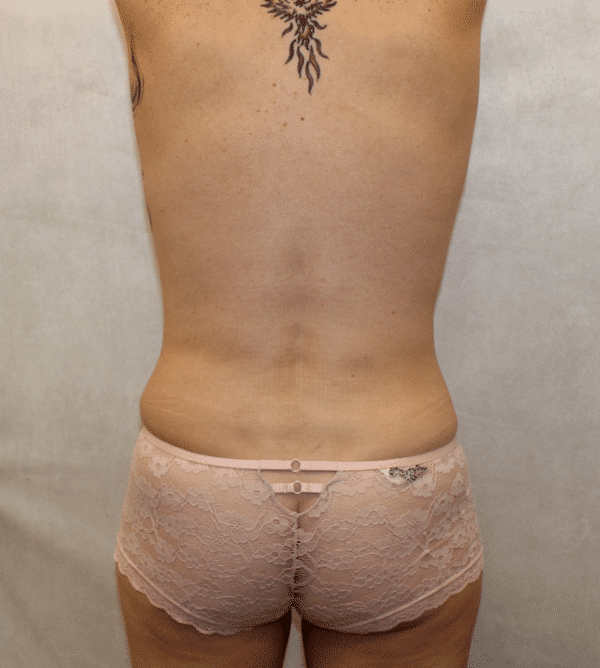 After Image: Case #3757 – Abdominoplasty – Tummy Tuck - back