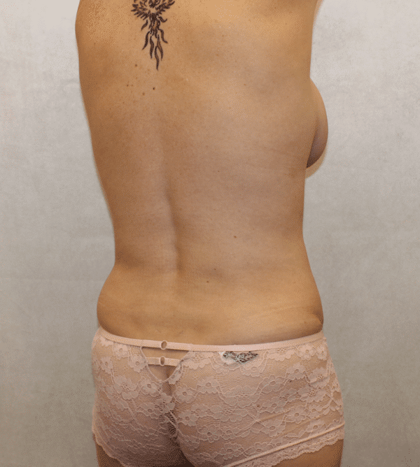 After Image: Case #3757 – Abdominoplasty – Tummy Tuck - right-back-oblique