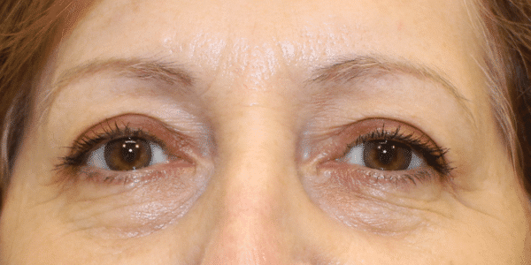 After Image: Case #3790 – Eye Lift (Blepharoplasty) - front