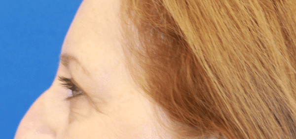 After Image: Case #3790 – Eye Lift (Blepharoplasty) - left-side