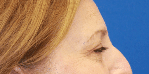 After Image: Case #3790 – Eye Lift (Blepharoplasty) - right-side
