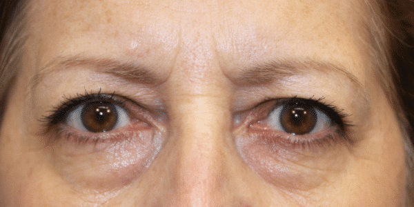 Before Image: Case #3790 – Eye Lift (Blepharoplasty) - front