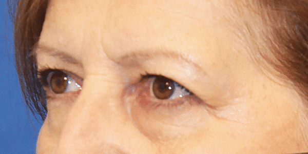 Before Image: Case #3790 – Eye Lift (Blepharoplasty) - left-front-oblique