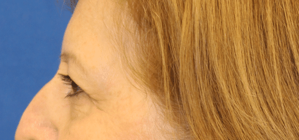 Before Image: Case #3790 – Eye Lift (Blepharoplasty) - left-side