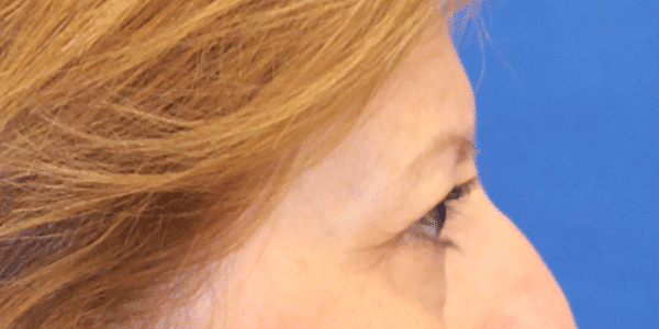 Before Image: Case #3790 – Eye Lift (Blepharoplasty) - right-side