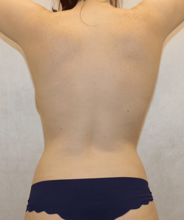 After Image: Case #3814 – Breast Augmentation - back