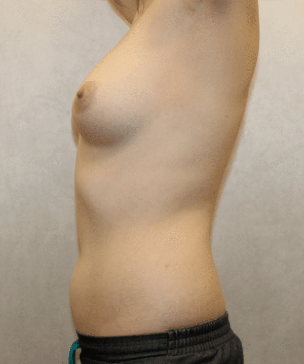 Before Image: Case #3814 – Liposuction - left-side