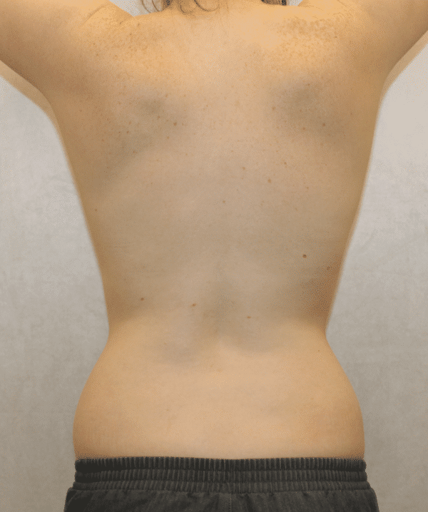 Before Image: Case #3814 – Liposuction -
