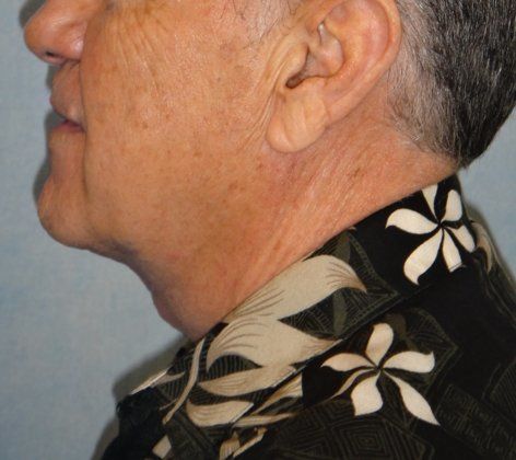 After Image: Case #383 – Neck Lift – Direct (For Men)