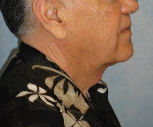 After Image: Case #383 – Neck Lift – Direct (For Men) - right-side