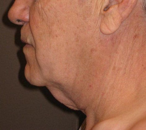 Before Image: Case #383 – Neck Lift – Direct (For Men)