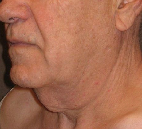 Before Image: Case #383 – Neck Lift – Direct (For Men) - left-front-oblique