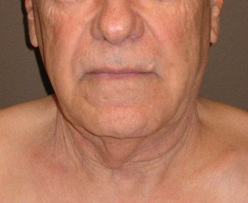 Before Image: Case #383 – Neck Lift – Direct (For Men) - front