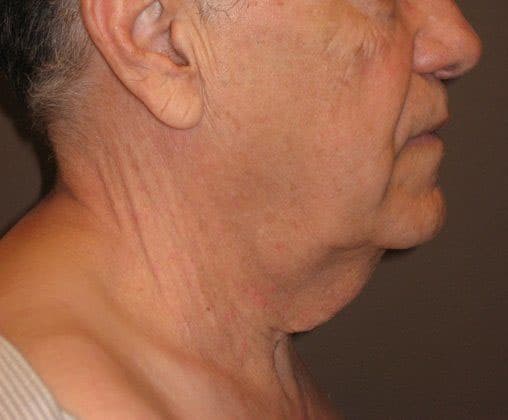 Before Image: Case #383 – Neck Lift – Direct (For Men) - right-side
