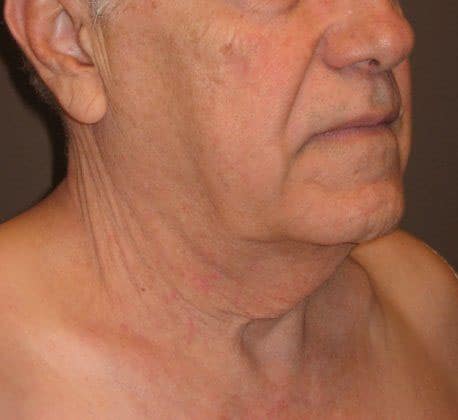 Before Image: Case #383 – Neck Lift – Direct (For Men) - right-front-oblique