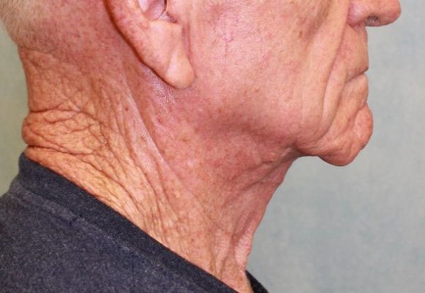 After Image: Case #395 – Neck Lift – Direct (For Men) -