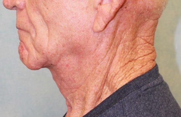 After Image: Case #395 – Neck Lift – Direct (For Men) - left-side