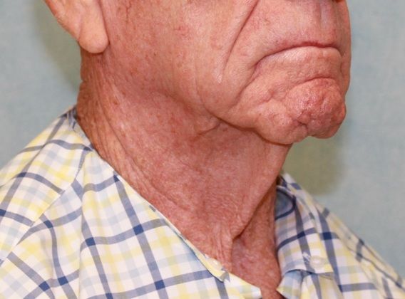 Before Image: Case #395 – Neck Lift – Direct (For Men) -