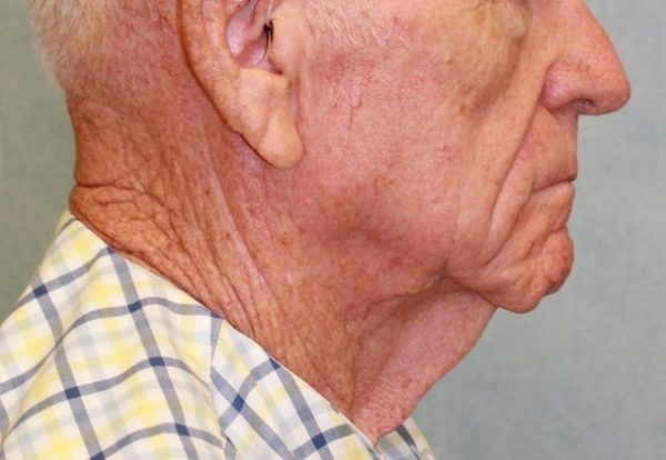 Before Image: Case #395 – Neck Lift – Direct (For Men) -