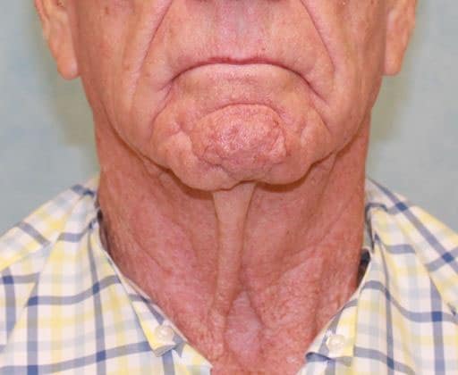 Before Image: Case #395 – Neck Lift – Direct (For Men) -