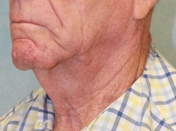 Before Image: Case #395 – Neck Lift – Direct (For Men) -