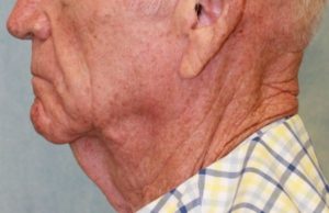 Case #395 – Neck Lift – Direct (For Men)