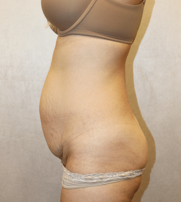 Before Image: Case #4057 – Abdominoplasty – Tummy Tuck - left-side