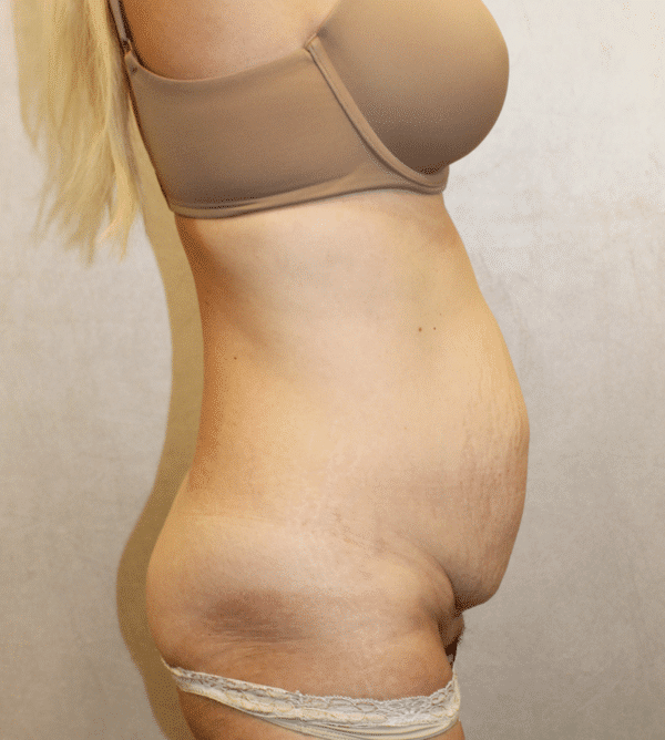 Before Image: Case #4057 – Abdominoplasty – Tummy Tuck - right-side