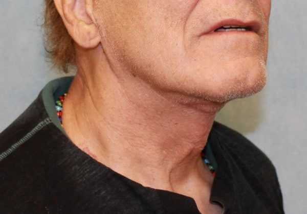 After Image: Case #407 – Neck Lift – Direct (For Men) - right-front-oblique