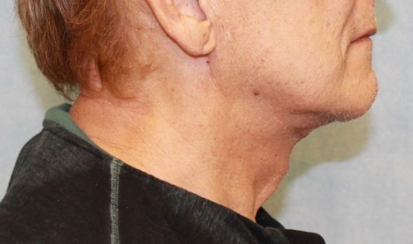 After Image: Case #407 – Neck Lift – Direct (For Men)