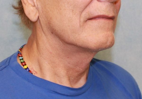 Before Image: Case #407 – Neck Lift – Direct (For Men) - right-front-oblique