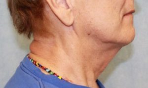 Case #407 – Neck Lift – Direct (For Men)