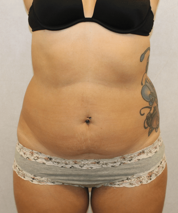 Case #4103 – Liposuction