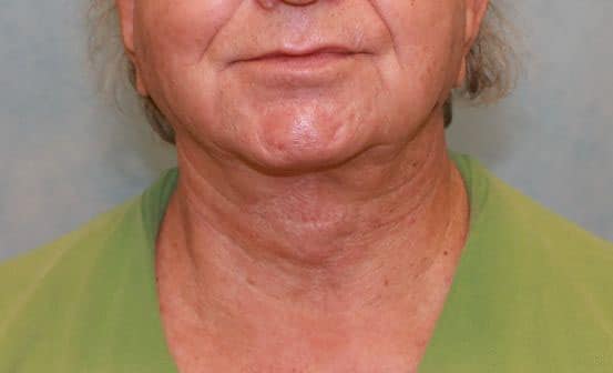 After Image: Case #413 – Neck Lift – Direct (For Men) - front