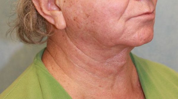 After Image: Case #413 – Neck Lift – Direct (For Men) - right-front-oblique