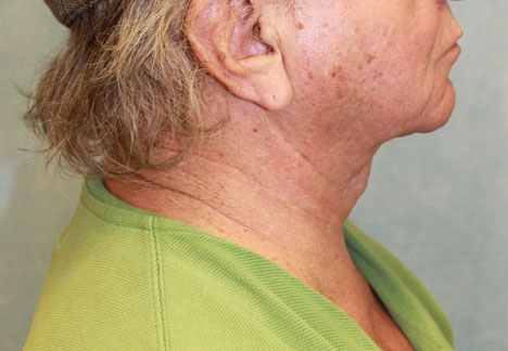 After Image: Case #413 – Neck Lift – Direct (For Men) - right-side