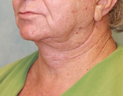 After Image: Case #413 – Neck Lift – Direct (For Men) - left-front-oblique