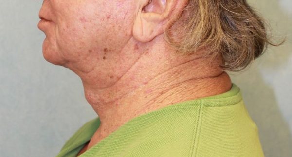 After Image: Case #413 – Neck Lift – Direct (For Men)