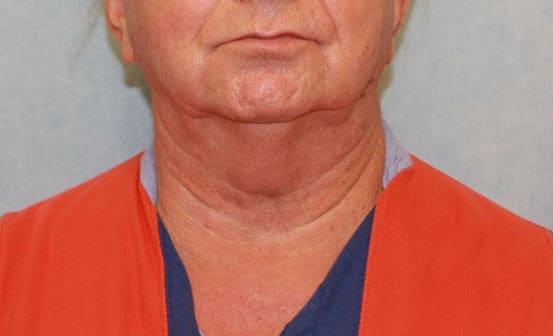 Before Image: Case #413 – Neck Lift – Direct (For Men) - front