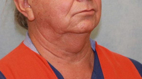 Before Image: Case #413 – Neck Lift – Direct (For Men) - right-front-oblique