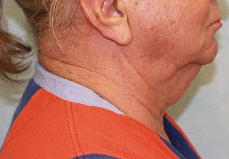 Before Image: Case #413 – Neck Lift – Direct (For Men) - right-side