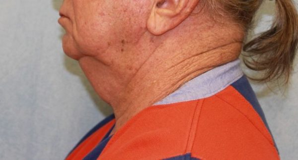 Before Image: Case #413 – Neck Lift – Direct (For Men)